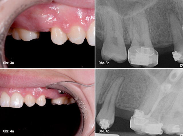 Předoperační snímek a boční  fotografie oblasti 15 a 25