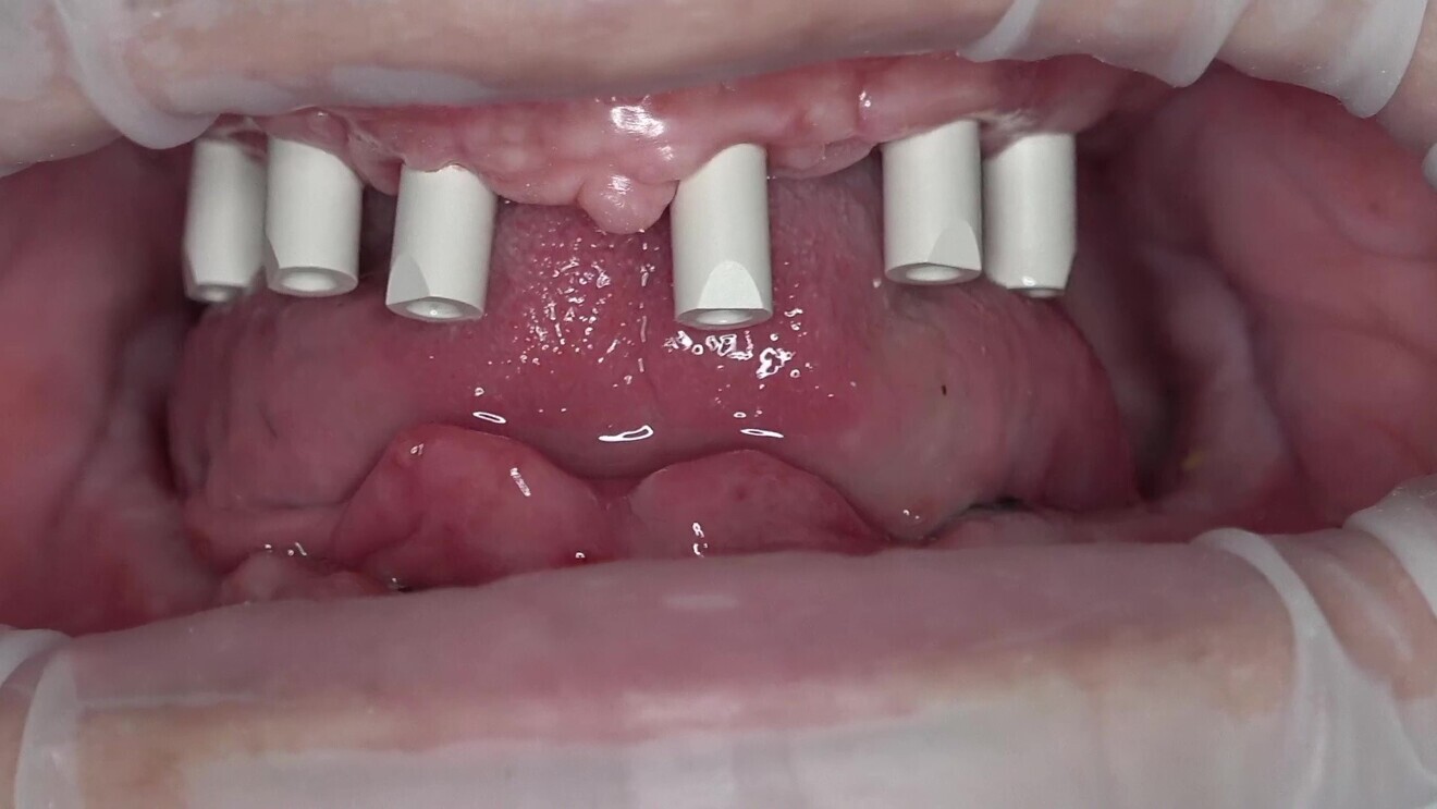 Fig. 3: Scan bodies in situ for intra-oral scanning.