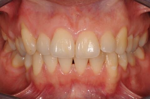 Figg. 2a-2c - Foto intraorali pretrattamento: visioni frontale (a), laterali (b).