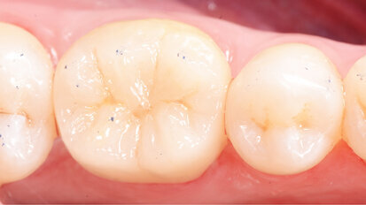 New materials for a classic indication