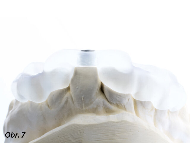 Adaptace vytištěné šablony na původní sádrový model.