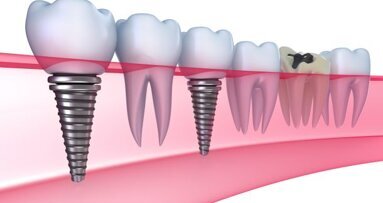 Kaakchirurg UMCG weigert mondimplantaten bij rokers