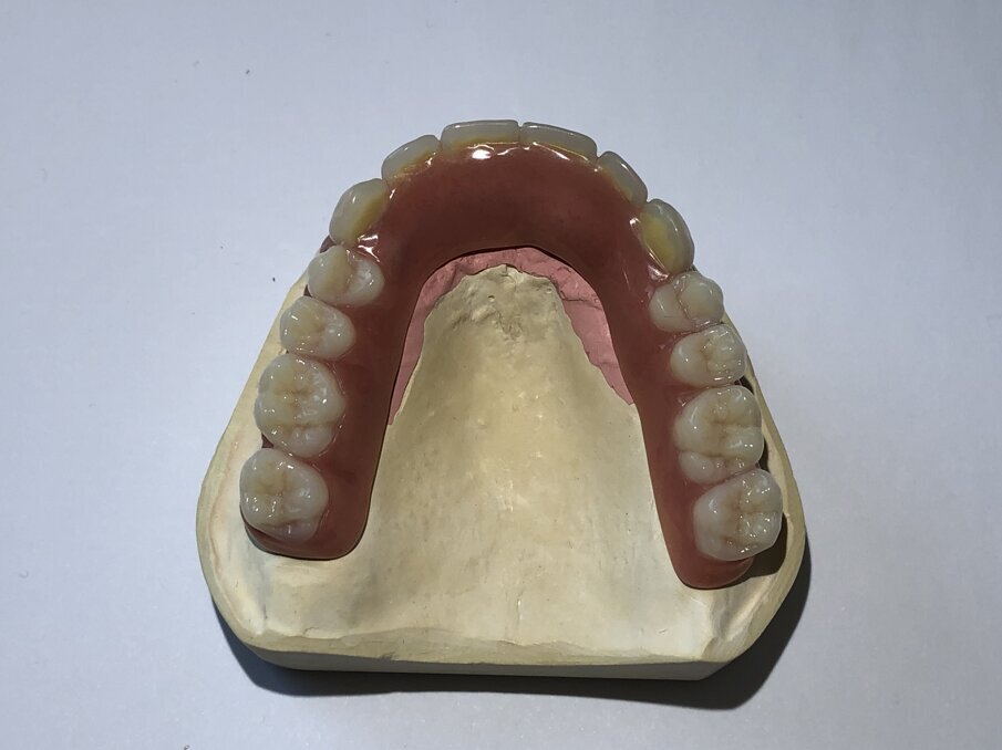 Afbeelding 15. Gehemeltevrije protheses op staafconstructie.