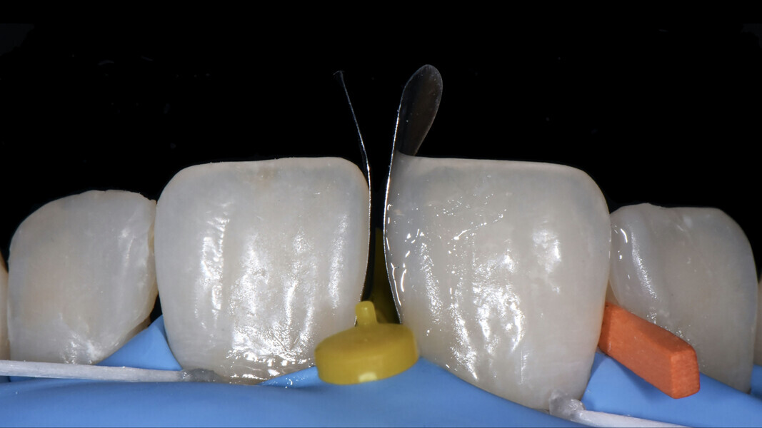 Fig. 10: Simultaneous use of the two matrices (placed vertically).