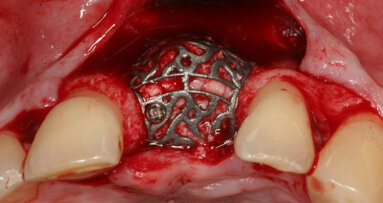 Individualized CAD/CAM-produced titanium scaffolds for alveolar bone augmentation