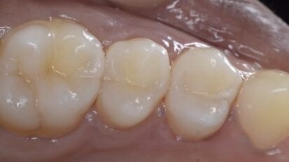 Keys to predictable posterior restorations: Bulkfill and modern matrix systems