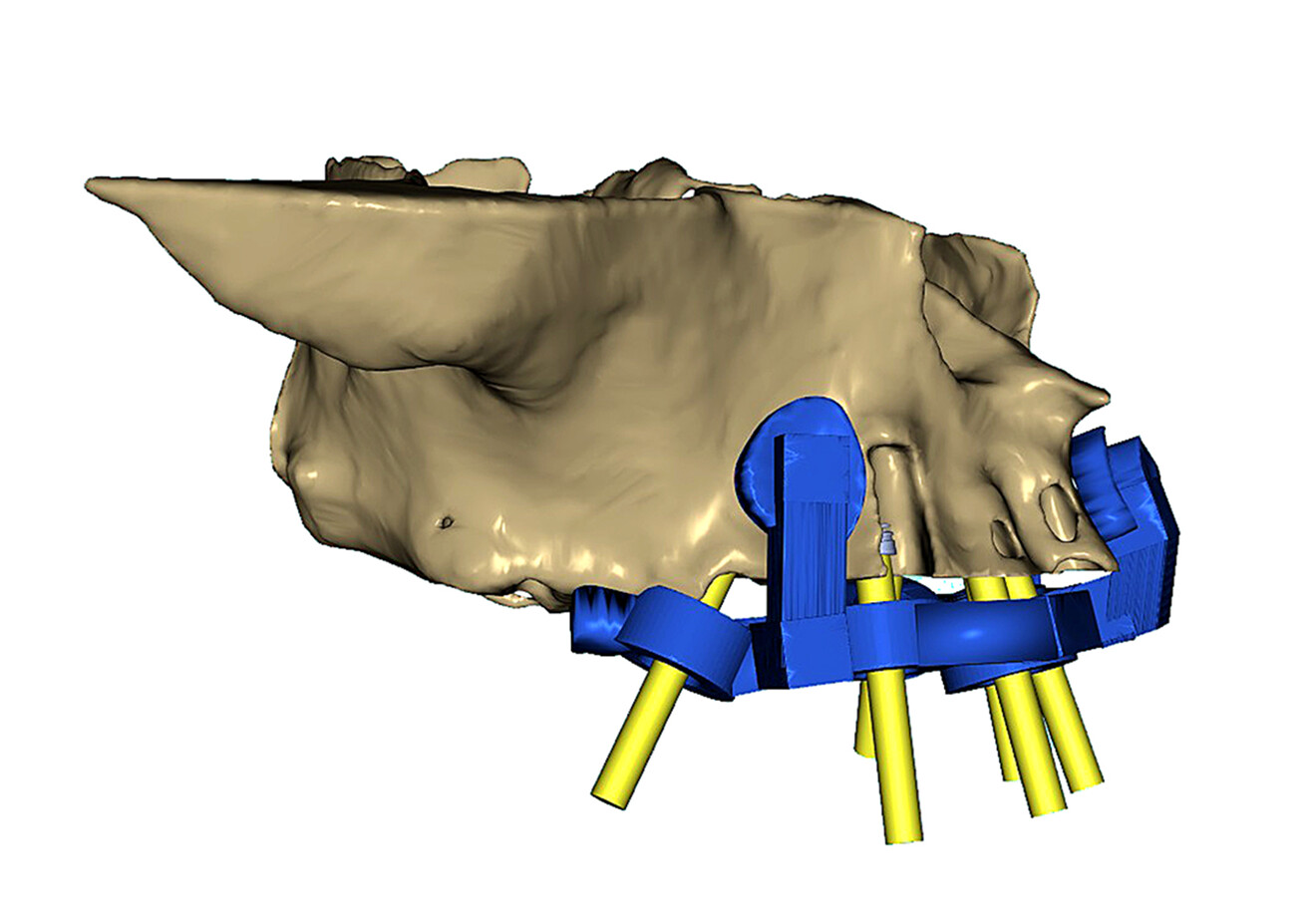 Fig. 8b: Simulation of the maxillary surgical guide in place. Right lateral view showing the anterior and posterior rest seats, the posterior tilted implant visualised with a yellow abutment projection, and bony fenestrations.