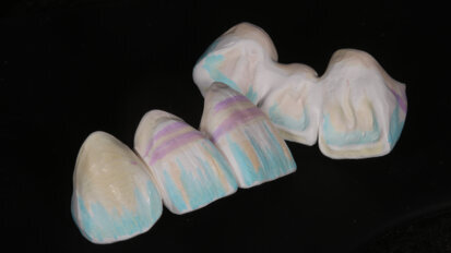 Fig. 9: Vestibular and palatal surfaces individualised with Esthetic Colorant to create and intensify some natural colour effects.