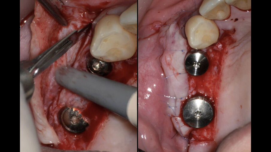 Fig. 15 -  Sutura della seconda fase implantare con vestiboloplastica.