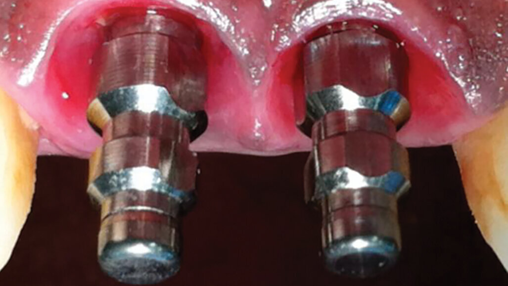 ULTRATOOTH: One visit, one hour, new tooth