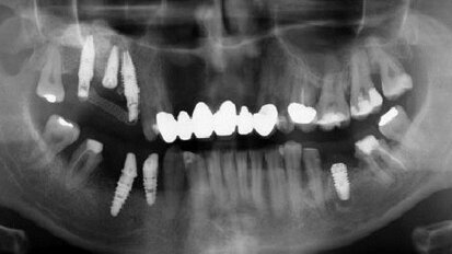 Guarire meglio, più rapidamente e con meno dolore con il PRGF