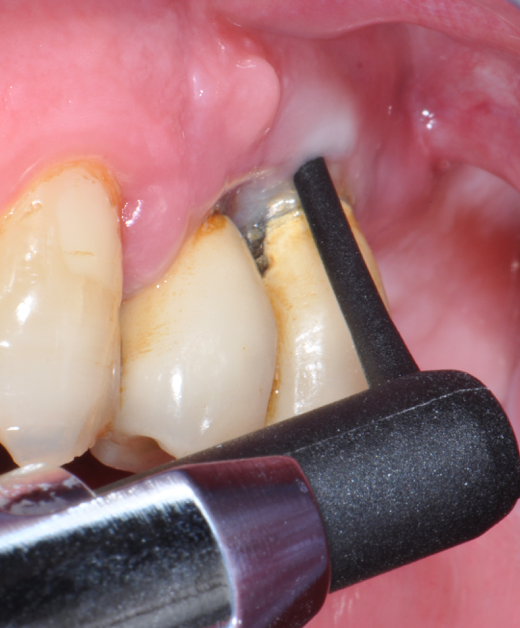 Fig.14: Case 2. First application of doxycycline 14%.