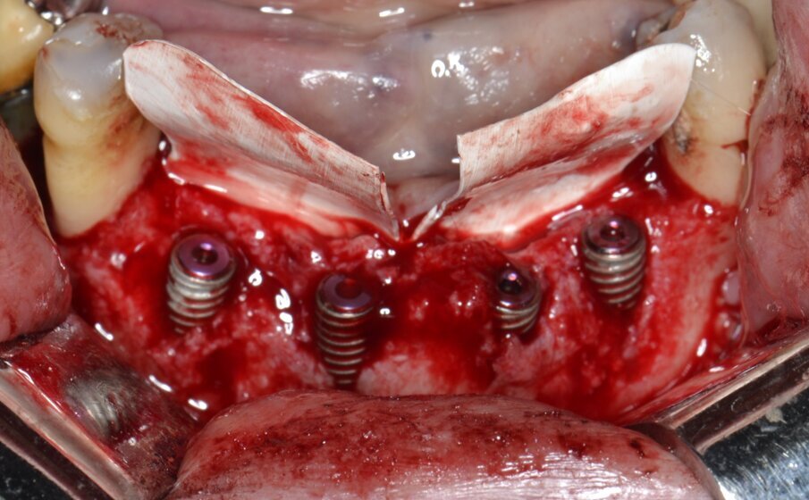 Fig. 8 - Posizionamento e fissazione di due membrane non riassorbibili in PTFE sul versante orale.