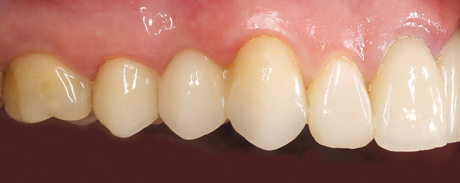 Fig. 29: IPS e.max CAD allows the fabrication of restorations for esthetically sensitive areas without the need for veneering them.