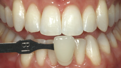 Técnica de aclaramiento dental en el consultorio