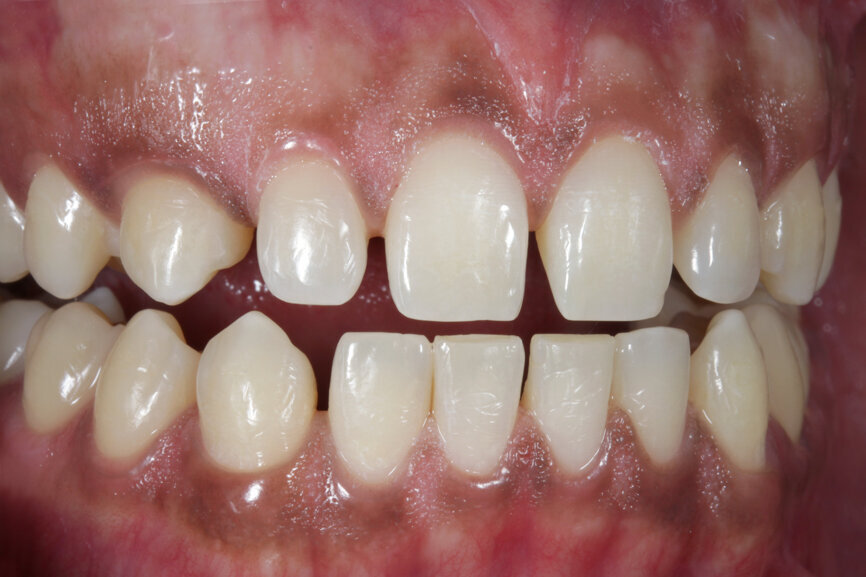 Fig. 2: Initial situation with diastemas in the upper and lower jaws.