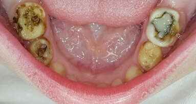 Indicatie narcose bij kinderen te vaak ongegrond