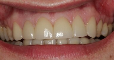 Przywrócenie estetyki uśmiechu w odcinku przednim szczęki przy pomocy technologii CAD/CAM