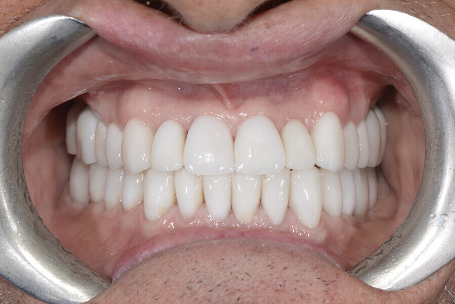 Fig. 27e: Final situation of the teeth in intercuspal position.