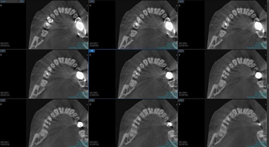 Fig.2b: Pre-op CBCT images of tooth #46: No obturation material in the distal and mesiobuccal canal (a); scanty obturation of the canals and breach of the floor of the pulp chamber, no obturation beyond a few millimetres down the orifice (b & c); radiolucency in the furcation area and periapical region of both roots (d -g).