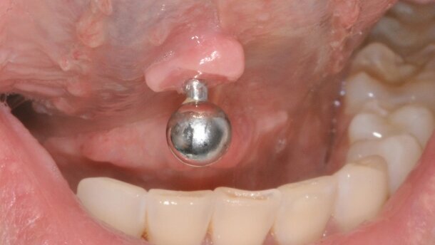 Przerost błony śluzowej języka związany z użytkowaniem kolczyka – opis przypadku