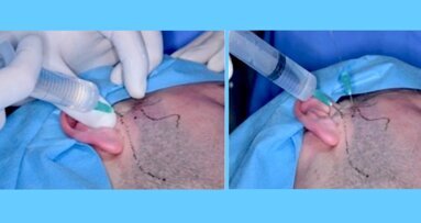 Tratamiento quirúrgico mínimamente invasivo de la ATM (1)