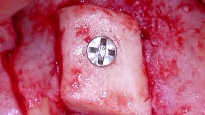 Innesti ossei e implantologia a protesizzazione immediata in zone ad alta valenza estetica