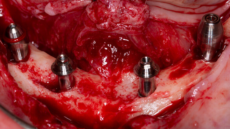Impianti sotto-crestali GTB e impianti zigomatici per la riabilitazione dei mascellari atrofici