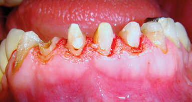 Gengivoplastica con laser a diodo: rapidità, efficacia, mininvasività e predicibilità