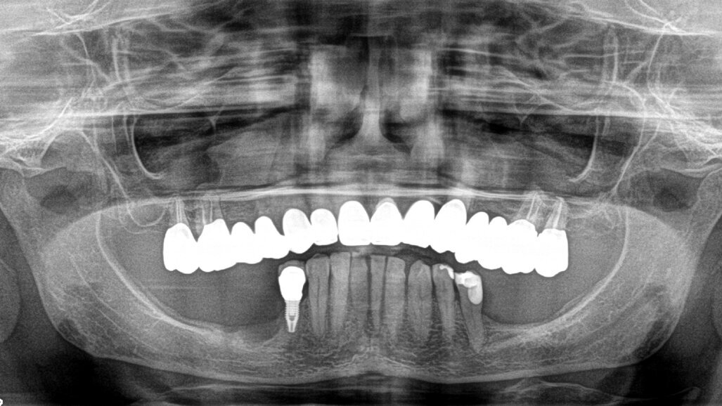 Restauro di una mandibola atrofica mediante impianti di 4,5 millimetri di lunghezza
