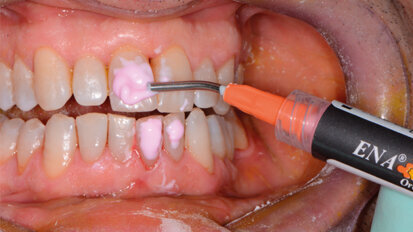 Il trattamento di sbiancamento autogestito dal paziente. Un rischio per la salute del cavo orale. Case report