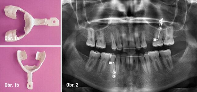 NaviStent chirurgická dlaha, Předoperační panoramatický RTG snímek