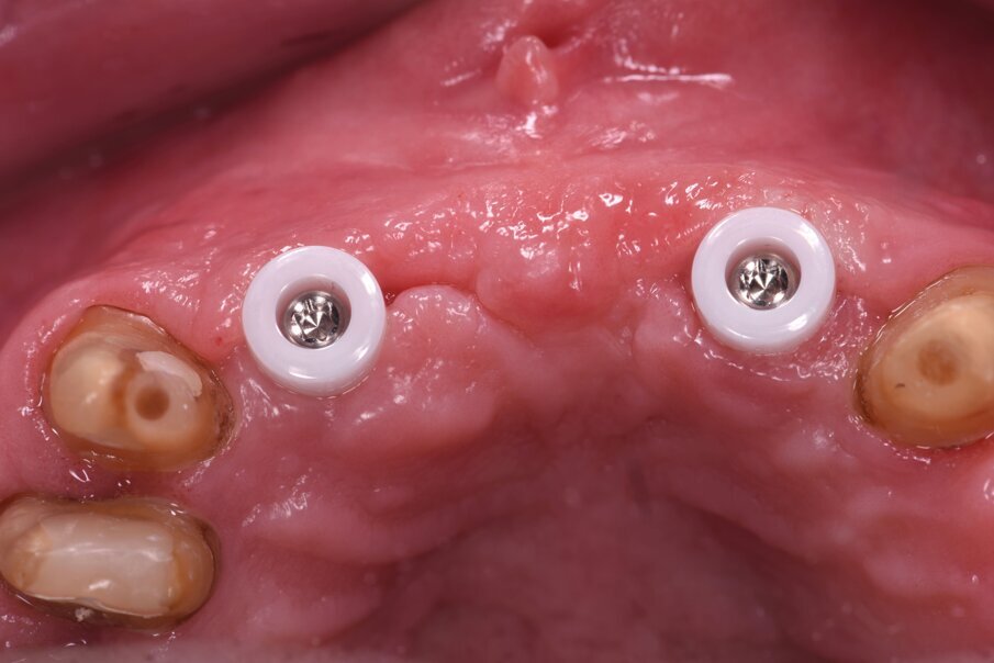 Fig. 26_Al termine dell’impronta si posizionano delle cappette di guarigione in zirconia in grado di stabilizzare il tessuto gengivale.