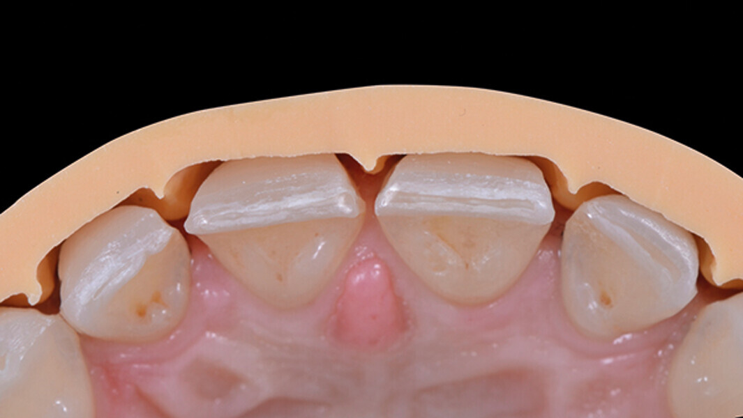 Fig. 9b. Verificación de la profundidad de la preparación, con la guía de silicona, lado palatino.
