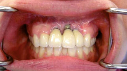 Profilassi di successo delle perimplantiti