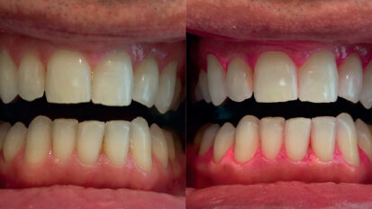 Analisi dei risultati ottenuti con un trattamento sbiancante post igiene