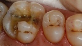 Nuevo detector de caries Facelight