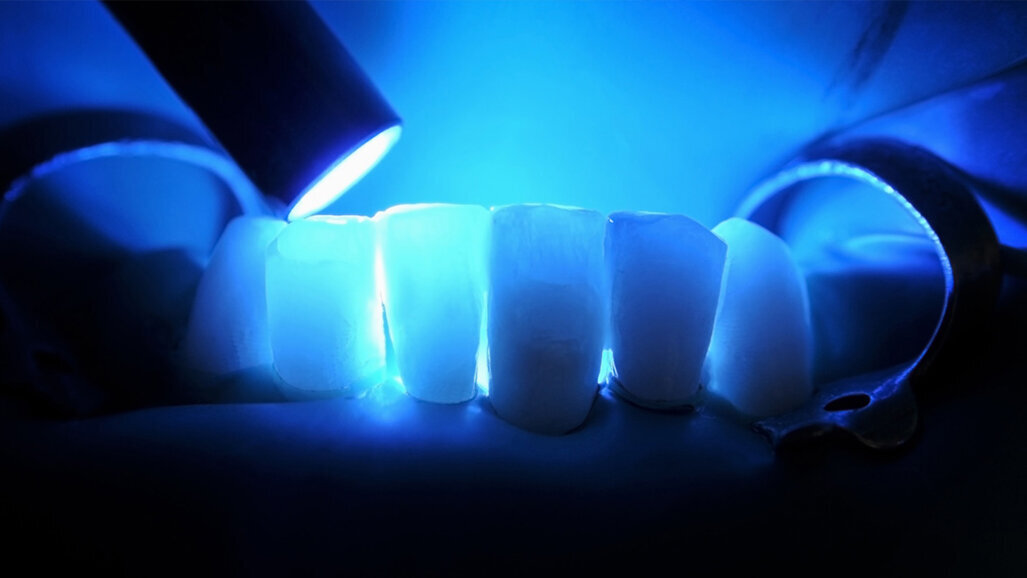 Researchers use AI to predict dental composite performance