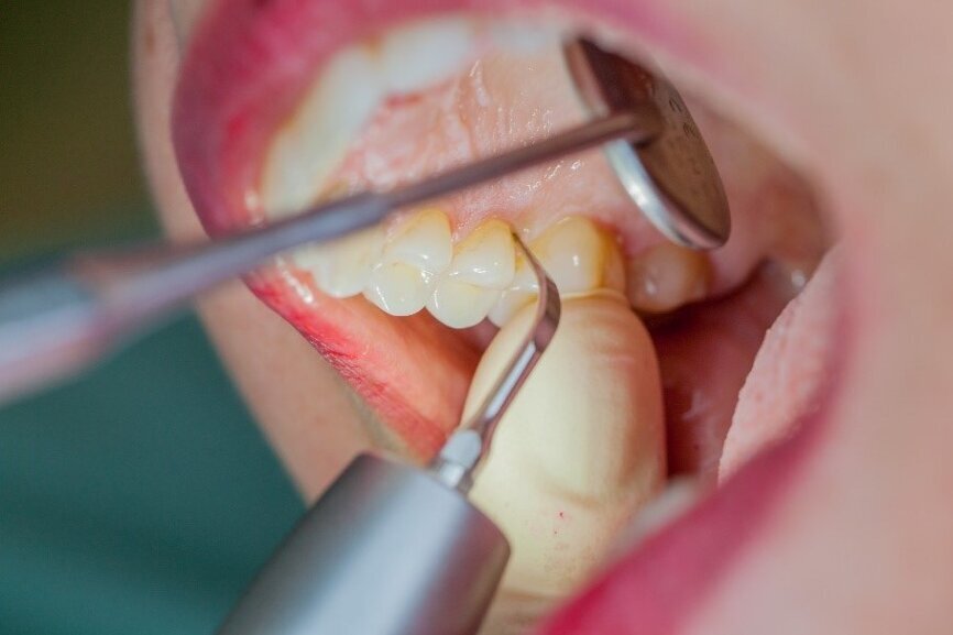 Fig. 4: Ultrasound devices are particularly suitable for UPT, for example in combination with periodontal tips (W&H Tigon (+) with 1P tip). (Photograph: W&H)