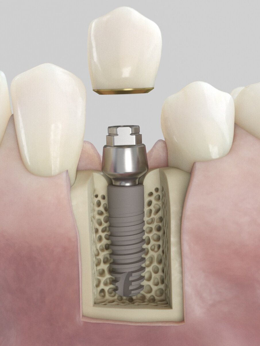Fig.1 - Acuris si basa su un concetto conometrico che utilizza la frizione invece di viti o cemento per fissare la corona e la cappetta all’abutment nella fase protesica finale del trattamento implantare. 