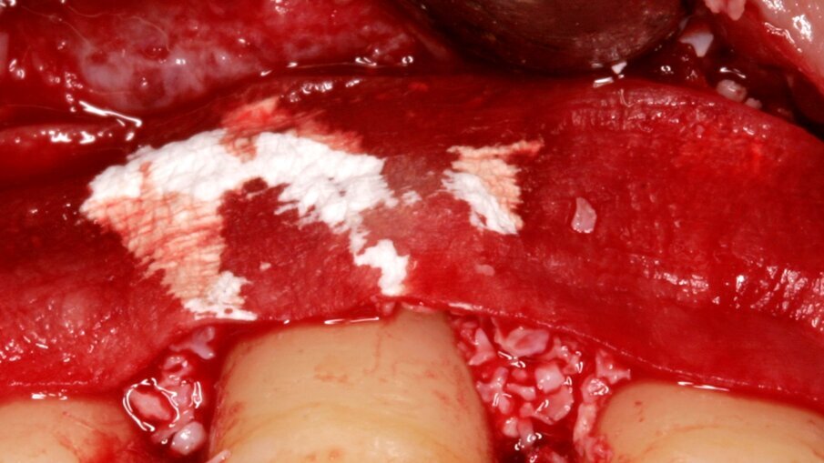 Fig.3: Membrane placed and stabilized 