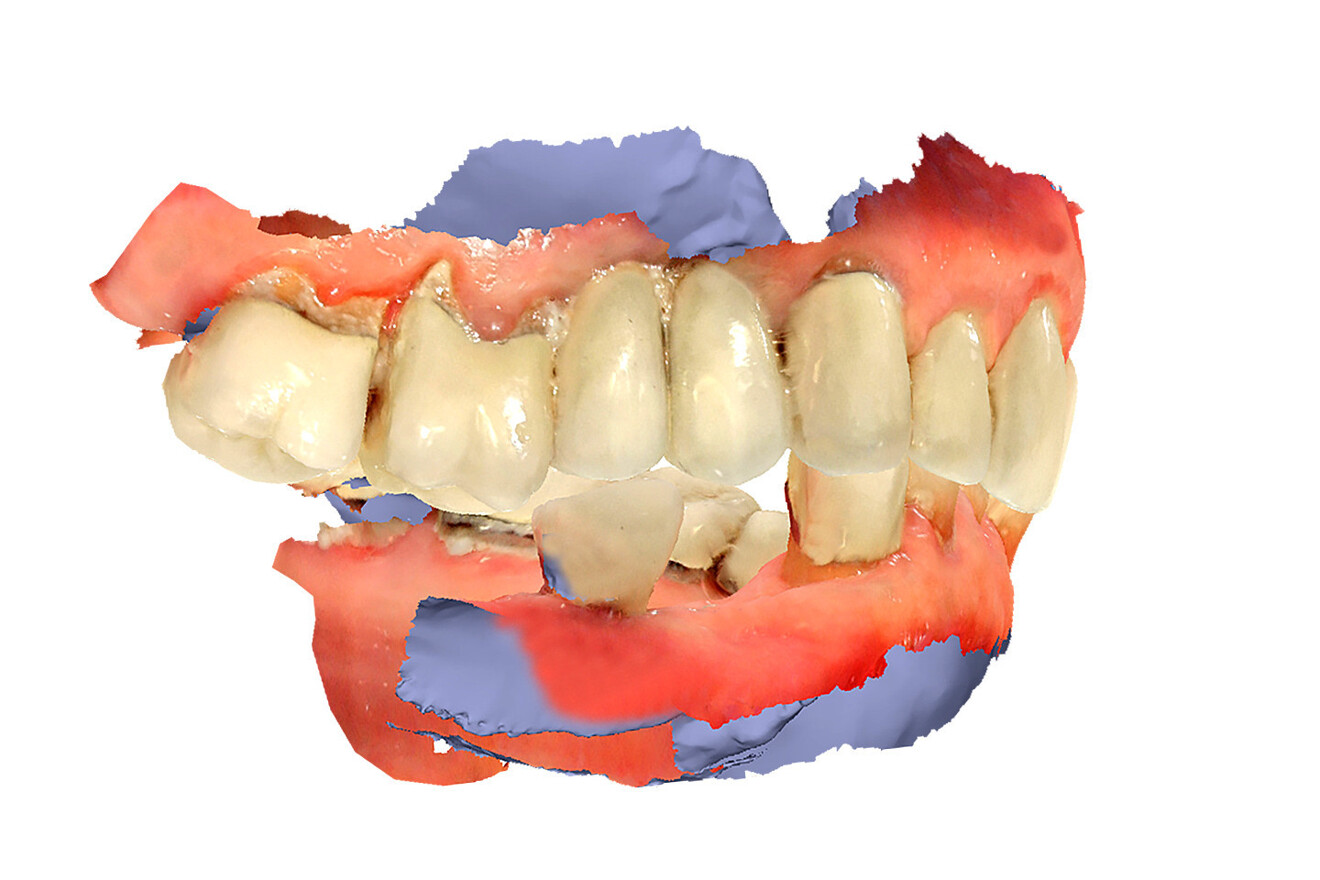 Fig. 3a: Intra-oral scan views of both arches demonstrating the severe malocclusion and narrow V-shaped arch form. Right lateral view.