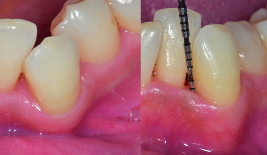 Fig. 8 - Visione occlusale del difetto trattato a 90 giorni di follow-up. La papilla è guarita con una retrazione del tessuto conseguente alla riduzione della profondità di tasca. La profondità di tasca si è ulteriormente ridotta: PPD di 2 mm e CAL 4 mm.