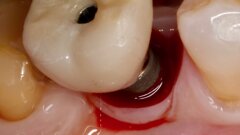 Interacción entre factores protésicos y sistémicos en la periimplantitis 