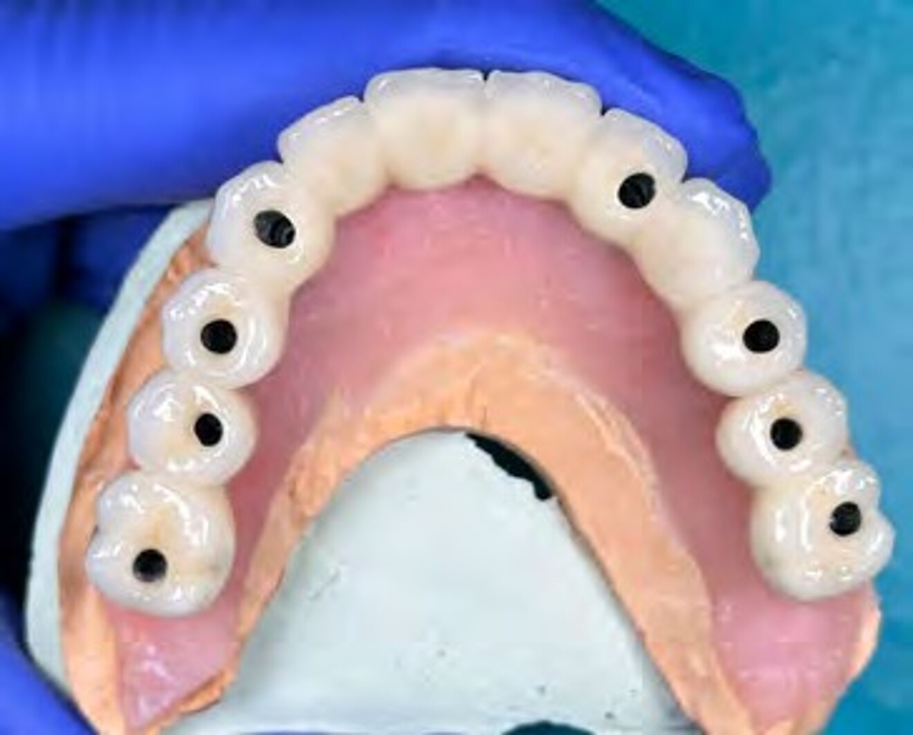 Fig. 3a: Intaglio view of the definitive maxillary implant-supported full-arch prosthesis demonstrating the screw-access channels for eight dental implants.