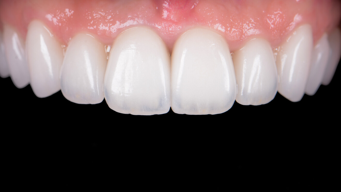 Fig. 31: Healthy gingival conditions observed one month after restoration placement.