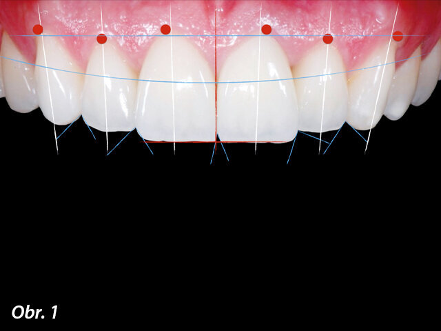 Ideální estetická kompozice frontálních zubů.