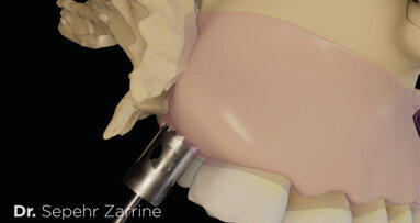 Carotte impactée transversalement.