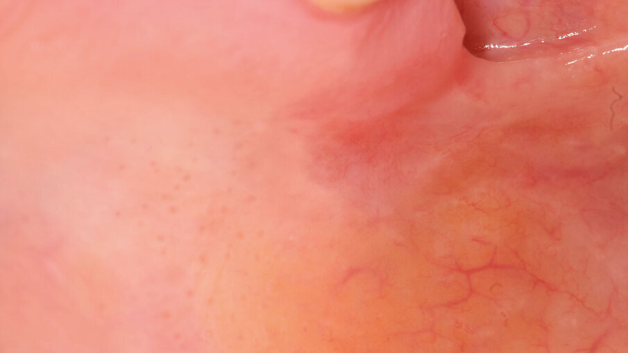 Fig. 5 - Guarigione dopo 18 giorni.