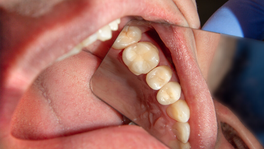 Protilab – Full Zircone